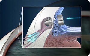 Istent Implant For Glaucoma Isec International Specialist Eye Centre Sg