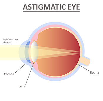 Astigmatism - Causes, Symptoms, Treatments | APEC