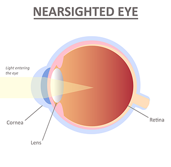 Nearsighted Eye Myopia Lee Hung Ming Eye Centre