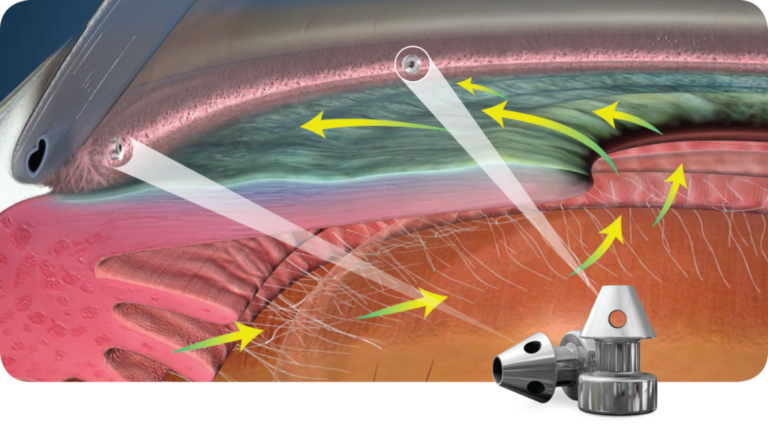 Glaucoma iStent Inject Process Animation