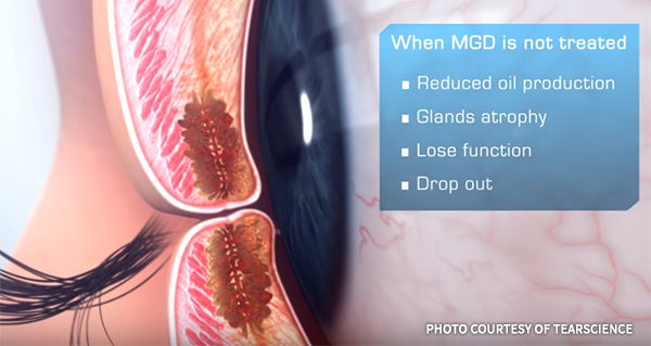 Lipiflow Treatment Meibomian Gland Dysfunction Meibomian Gland Atrophy Tear Science Asia Pacific Eye Centre APEC