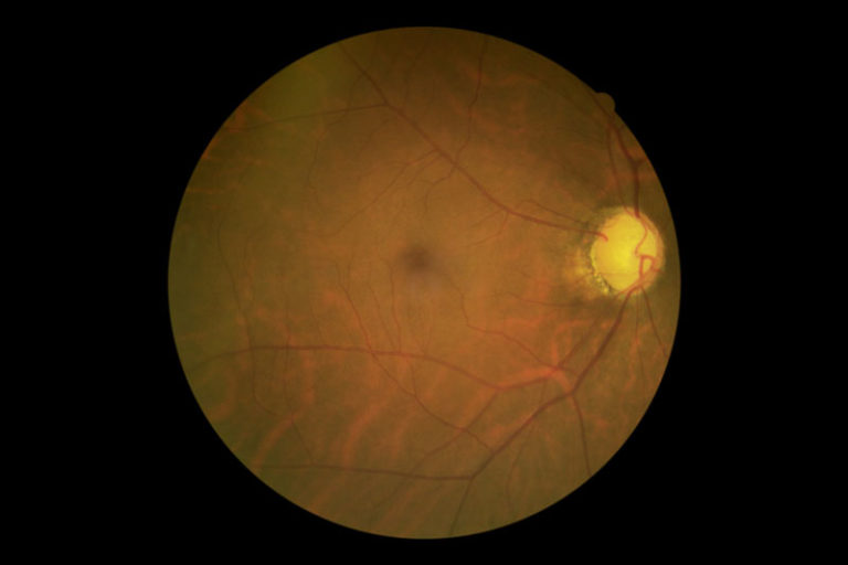 Glaucoma-Photo-Patient-Eye-Closeup