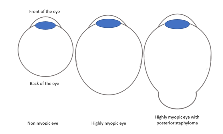 High Myopia - ISEC International Specialist Eye Centre SG