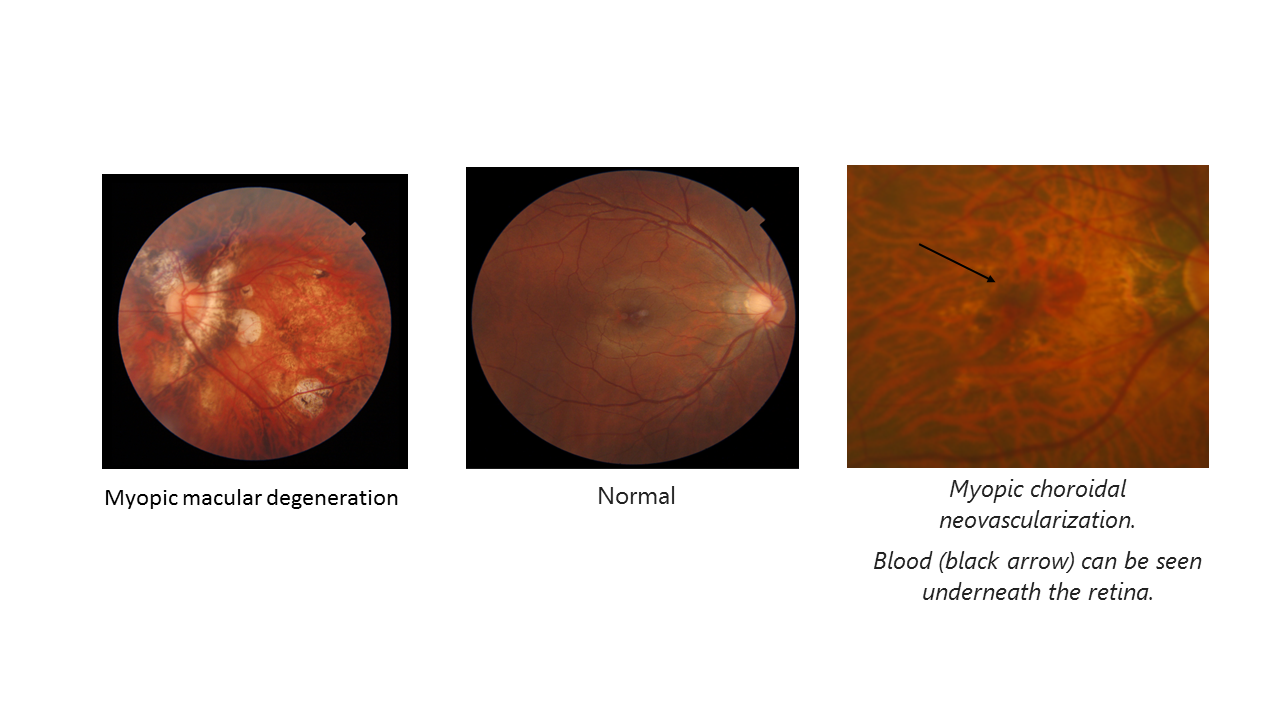 High Myopia - ISEC International Specialist Eye Centre SG