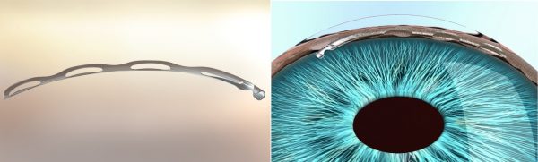 MIGS Stents for Glaucoma