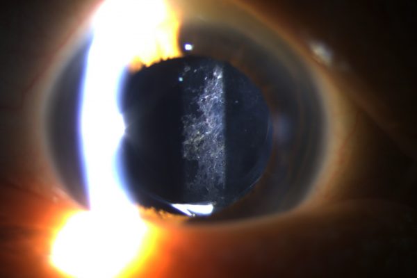 What Causes Pco After Cataract Surgery